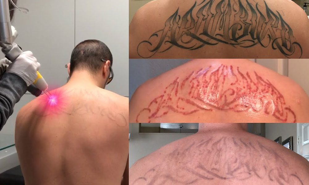 laser tattoo removal