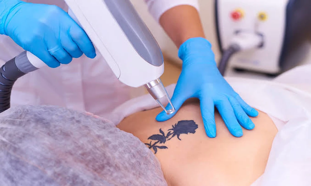 How Much Does Laser Tattoo Removal Cost, and Does Insurance Ever Cover It?