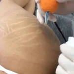 Stretch Mark Camouflage vs. Traditional Tattooing: What’s the Difference?
