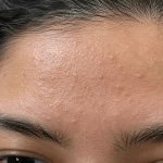 Tiny Bumps on Your Forehead? Why They Keep Coming Back and How to Clear Them